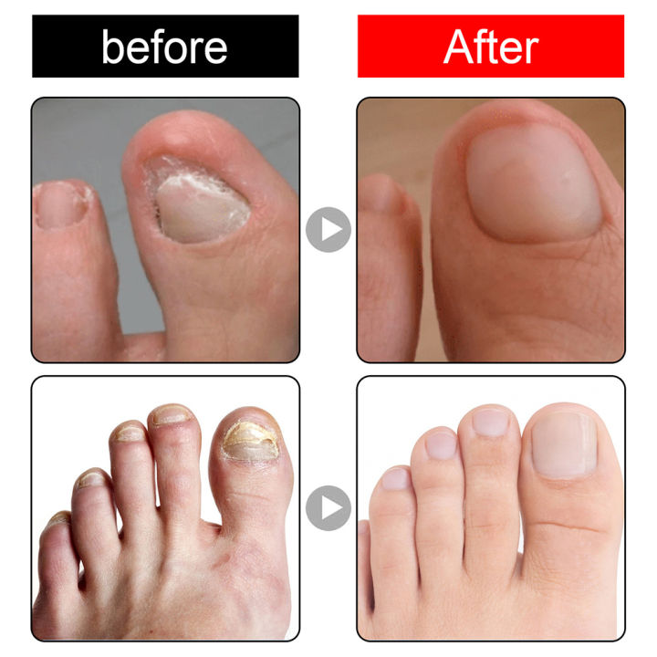 Ingrown%20Toenail%20Pain%20Relief%20Drops%20-%2030ml%20-%20Image%204