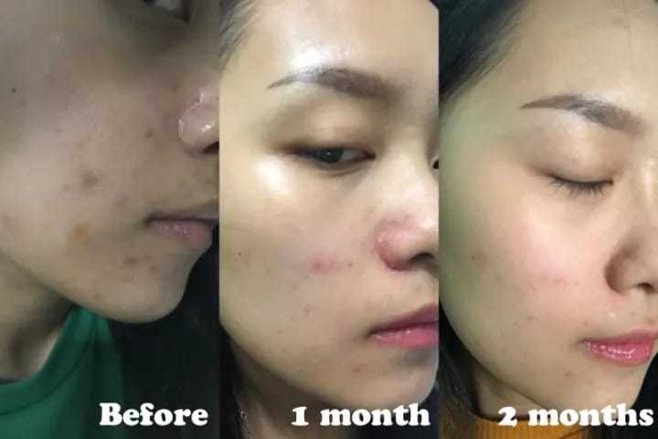 The%20Ordinary%20Salicylic%20Acid%202%25%20Solution%20Serum%20(30ml)%20-%20Image%208