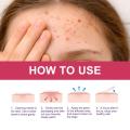 114 Counts Cute Bunny Animals Acne Pimple Patches Cover Stickers, Invisible Face Spot Pimple Concealer Makeup Tool. 