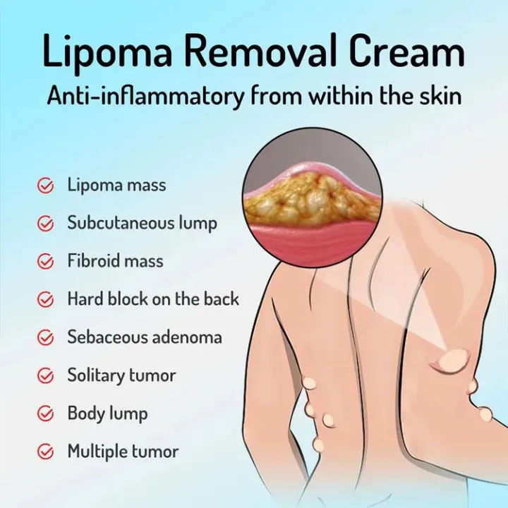 4pcs%20Lipoma%20Removal%20Cream%20%E2%80%93%20Herbal%20Natural%20Fat%20Lump%20Treatment%20%7C%20Sebaceous%20Cyst,%20Fibroma,%20Skin%20Lump,%20Fatty%20Tumor,%20Muscle%20Knot%20Removal%20Ointment%20%E2%80%93%2020g%20-%20Image%204