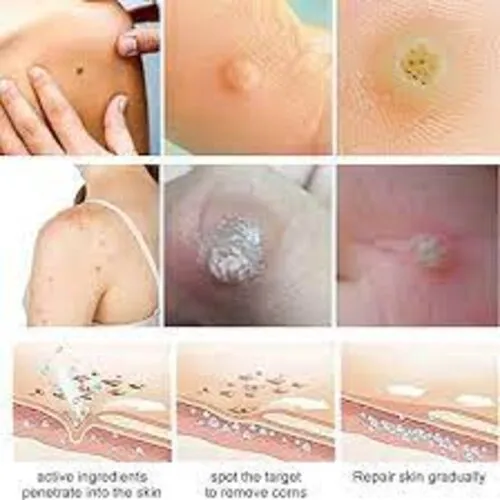 South%20Moon%20Pack%20Of%2024%20Footcorn%20Removal%20Plaster%20Ideal%20for%20Relief%20and%20Removal%20of%20Corns%20and%20Callouses%20-%20Image%202