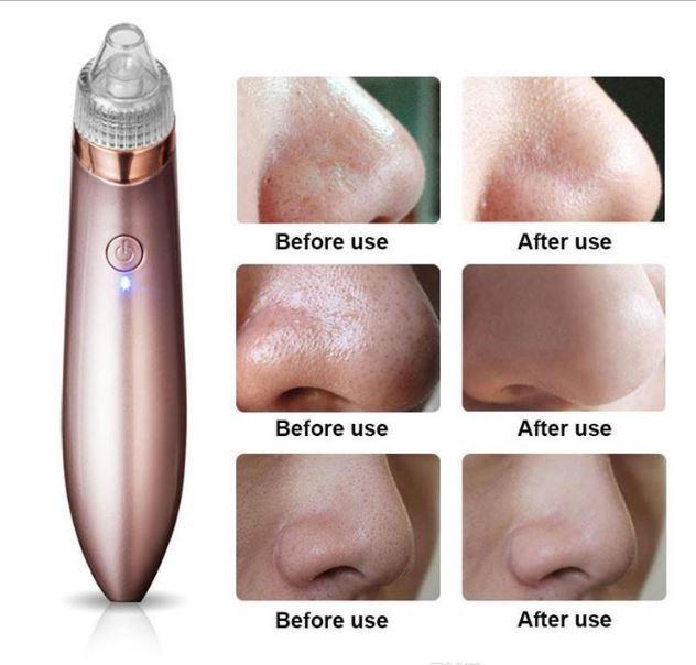 Black%20Head%20And%20Pimple%20Remover%20-%20Image%205