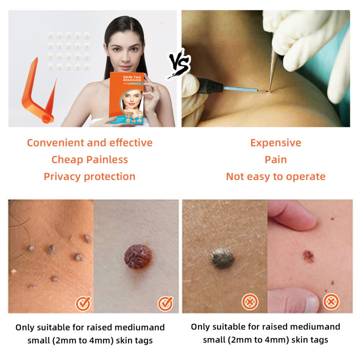 Painless%20Safe%20Skin%20Tag%20Remove%20Device%20Kit%20Micro%20Tags%20Sized(2mm%20to%204mm)%20Warts%20Remover%20Original%20Skin%20Band%20Tool%20Set%20-%20Image%203