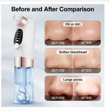Blackhead%20Remover%20Electric%20Black%20Head%20Remover%20Pore%20Vacuum%20Cleaner%20Micro%20Small%20Bubble%20Acne%20Black%20Head%20Extractor%20Black%20Dot%20Remove%20-%20Image%207