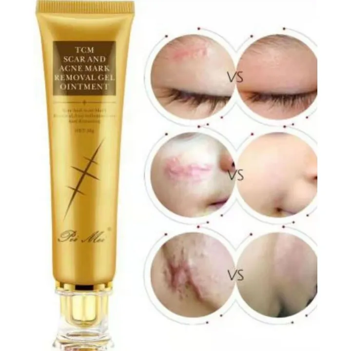 Original%20Scar%20and%20Acne%20Mark%20Removal%20Gel%20Stretch%20Marks/acne/scald/surgical%20Scars%20Treatment%20Cream%20Skin%20Care%2030%20Gram%20-%20Image%202