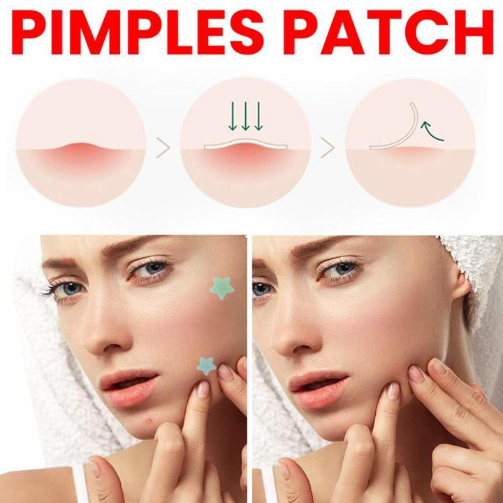 Fashion Sticking to the face and closing the invisible color combination of Xinxing 216PCS acne patch invisible acne waterproof and breathable skin
