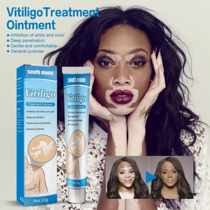 NUTRIG%20Vitiligo%20Treatment%20Cream%20for%20White%20Spots,%20Vitiligo%20Cream%20Treatment%20Ointment%20Leucoplia%20Relief%20Repair%20Melanin%2020g%20-%20Image%203