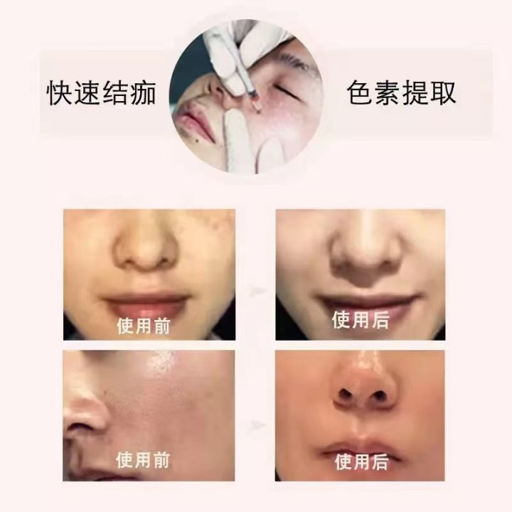 Special%20freckle%20removal%20liquid%20for%20beauty%20salons,%20freckles%20extract%20liquid,%20spot%20spot%20water,%20age%20spots,%20dermal%20spots,%20pigmentation,%20decomposition%20facial%20essence%20-%20Image%204