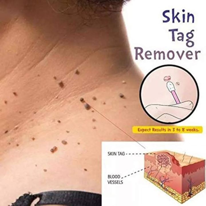 Kin Tag Liquid Nitro Skin Tag And Wart Treatment Papillomas Removal Off Warts Liquid Pen ...