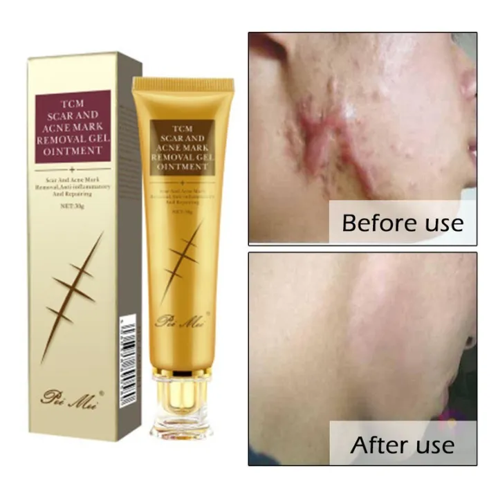 TCM%20Scar%20and%20Acne%20Marks%20Removal%20Gel,%20Scars,%20Burns,%20Stretch%20Marks,%20Acne%20Spots,%20Treatment%20Gel%20Ointment%20for%20Face%20and%20Body%2030g%20-%20Image%204