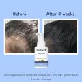 WishCare Hair Growth Serum For Scalp | 94% Saw New Hair Growth | Redensyl & Rosemary Oil | 100% Saw Hairfall Reduction | In-Vivo Tested | For Men & Women | 30ml. 