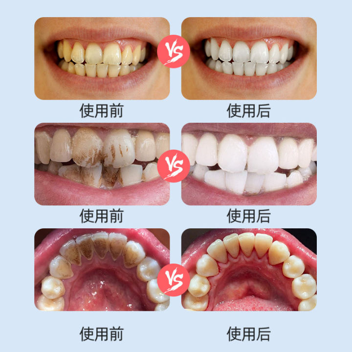 Oral%20teeth%20cleaner,%20children's%20tartar%20removal,%20tooth%20stain%20removal,%20tooth%20plaque,%20nano%20eraser%20sponge%20eraser%20-%20Image%203