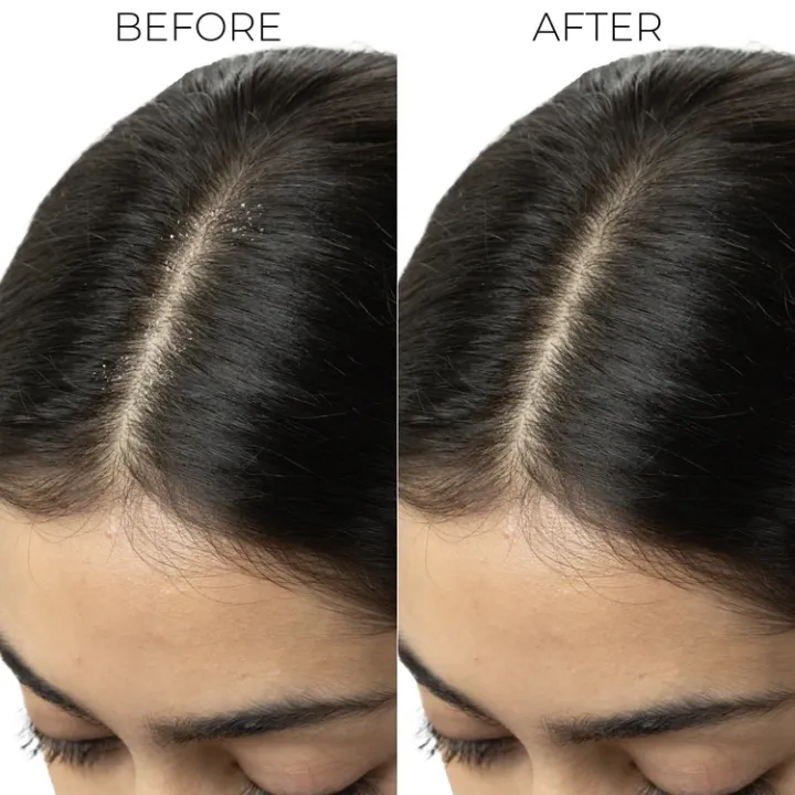 Brillare%20Dandruff%20Control%20Mask%20For%20Itchy,%20Flaky%20Scalp%20-%20125%20Gm%20-%20Image%205