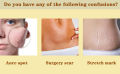 Scar Removal Cream - TCM Scar Cream for Surgical Scars, Acne Skin Care Cream, Acne Treatment Cream for Scars, Burns, Stretch Marks, Acne Spots. 