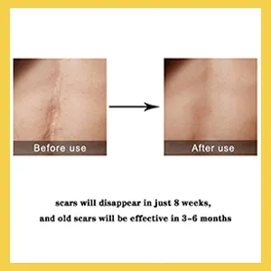 Scar%20Removal%20Cream%20-%20TCM%20Scar%20Cream%20for%20Surgical%20Scars,%20Acne%20Skin%20Care%20Cream,%20Acne%20Treatment%20Cream%20for%20Scars,%20Burns,%20Stretch%20Marks,%20Acne%20Spots%20-%20Image%203