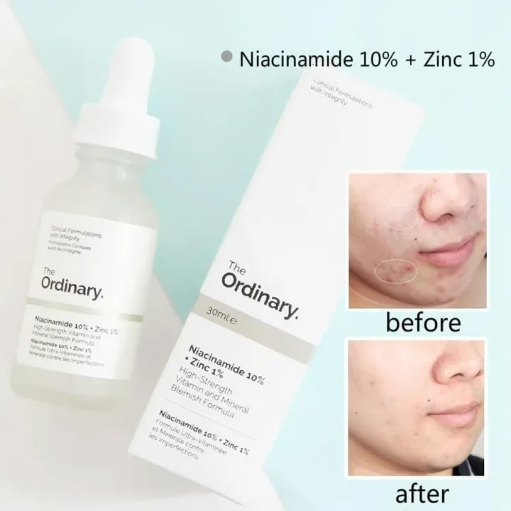 Niacinamide%20Serum%20In%20Nepal%2030ml%20-%20Treats%20Acne,%20Skin%20Redness,%20Pimples%20&%20Pores%20-%20Image%203