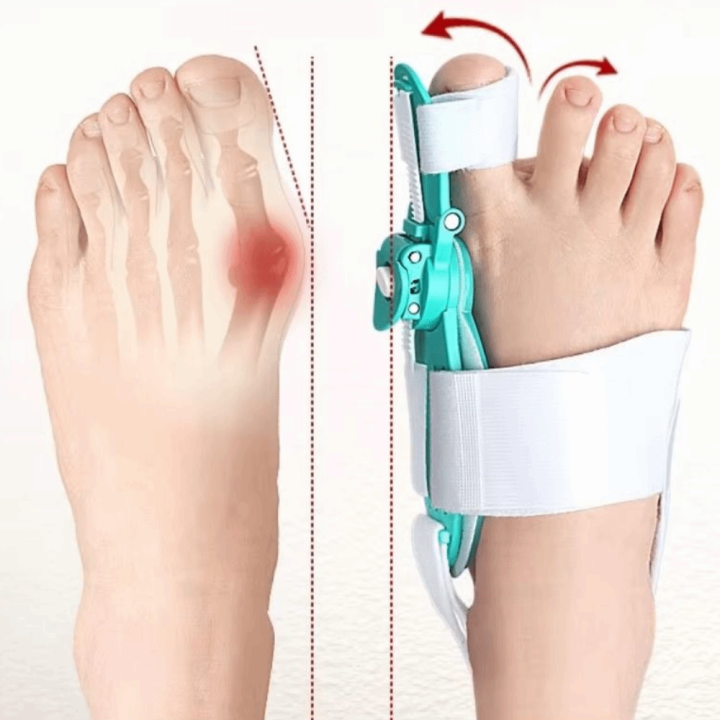 Toe Immobilization Toggle Adjustable Bunion Corrector Toe Valgus Bunion ...