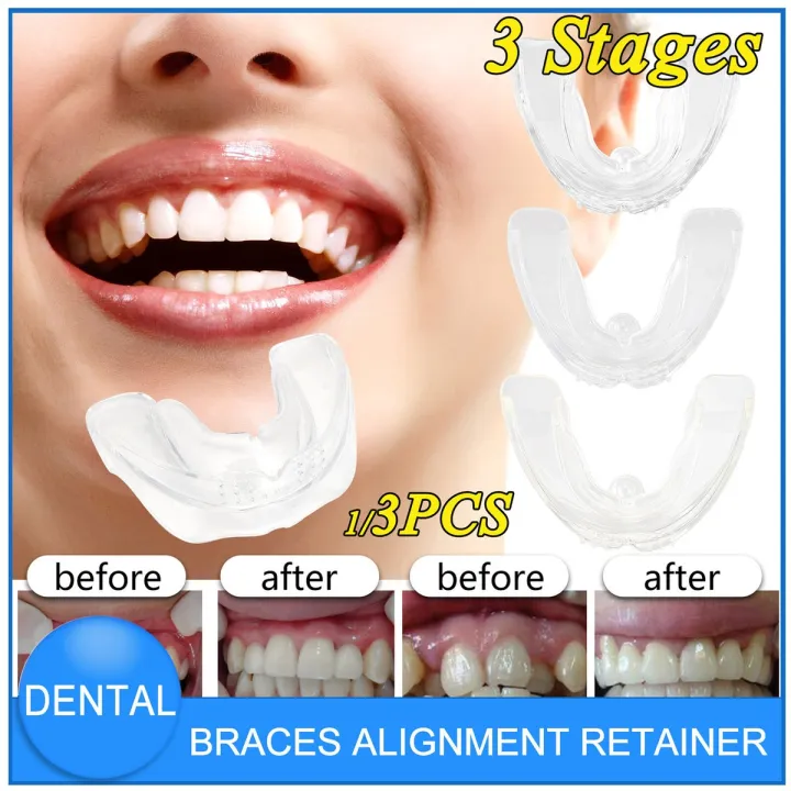 DealSpot%20Dental%20Orthodontic%20Teeth%20Corrector%20Braces%20%7C%20Removable%20Teeth%20Retainer%20&%20Alignment%20Trainer%20Tool%20%7C%20Reusable%20Dental%20Straightening%20Device%20for%20Oral%20Care,%20Smile%20Support%20(Adults%20&%20Teens)%20-%20Image%202