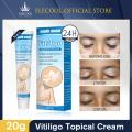 NUTRIG Vitiligo Treatment Cream for White Spots, Vitiligo Cream Treatment Ointment Leucoplia Relief Repair Melanin 20g. 