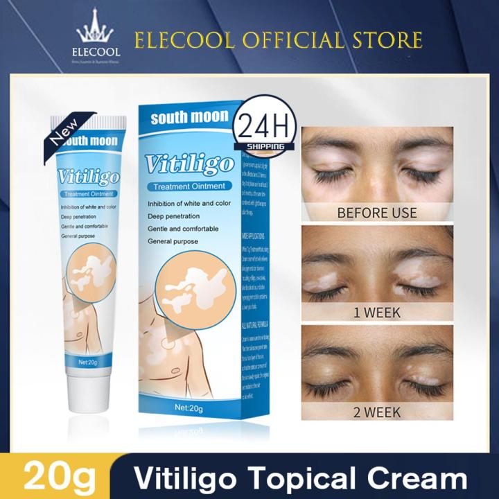 NUTRIG%20Vitiligo%20Treatment%20Cream%20for%20White%20Spots,%20Vitiligo%20Cream%20Treatment%20Ointment%20Leucoplia%20Relief%20Repair%20Melanin%2020g%20-%20Image%208