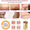 Scar Removal Cream - TCM Scar Cream for Surgical Scars, Acne Skin Care Cream, Acne Treatment Cream for Scars, Burns, Stretch Marks, Acne Spots. 