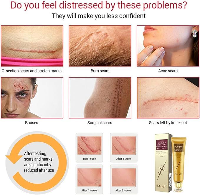 Original%20Scar%20and%20Acne%20Mark%20Removal%20Gel%20Stretch%20Marks/acne/scald/surgical%20Scars%20Treatment%20Cream%20Skin%20Care%20-%20Image%205