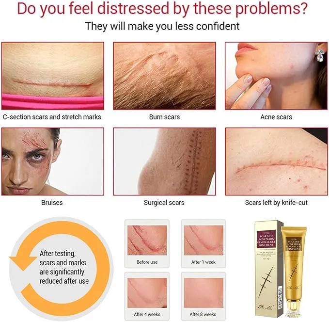 Scar%20Removal%20Cream%20-%20TCM%20Scar%20Cream%20for%20Surgical%20Scars,%20Acne%20Skin%20Care%20Cream,%20Acne%20Treatment%20Cream%20for%20Scars,%20Burns,%20Stretch%20Marks,%20Acne%20Spots%20-%20Image%206