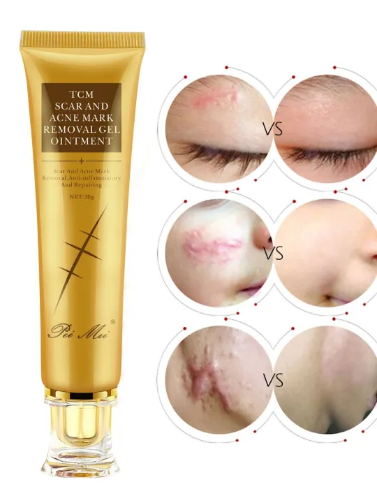 TCM%20Scar%20and%20Acne%20Marks%20Removal%20Gel,%20Scars,%20Burns,%20Stretch%20Marks,%20Acne%20Spots,%20Treatment%20Gel%20Ointment%20for%20Face%20and%20Body%2030g%20-%20Image%203
