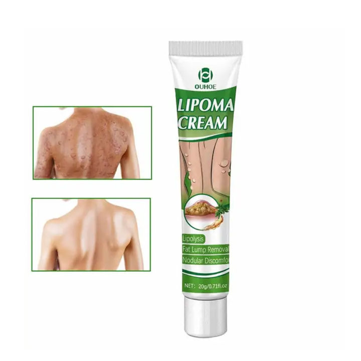 Ouhoe%20Instant%20Lipoma%20Removal%20Cream%20Lipolysis%20Fat%20Lump%20Relief%20Plaster%20Anti%20Swelling%20And%20Moisturizers-20gram%20-%20Image%203