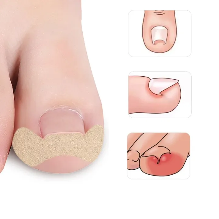 HOT%20Pexmen%206Pcs/Sheet%20Ingrown%20Toenail%20Correction%20Sticker%20Adhesive%20Toenail%20Patch%20Toe%20Nail%20Treatment%20Corrector%20Foot%20Care%20Tool%20-%20Image%202