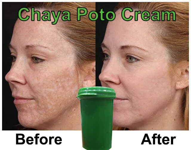 Chaya%20Poto%20Cream%20Dark%20Spot%20Freckle%20Melasma%20Day%20&%20Night%20Moisturizing%20Cream%20-30g%20-%20Image%202