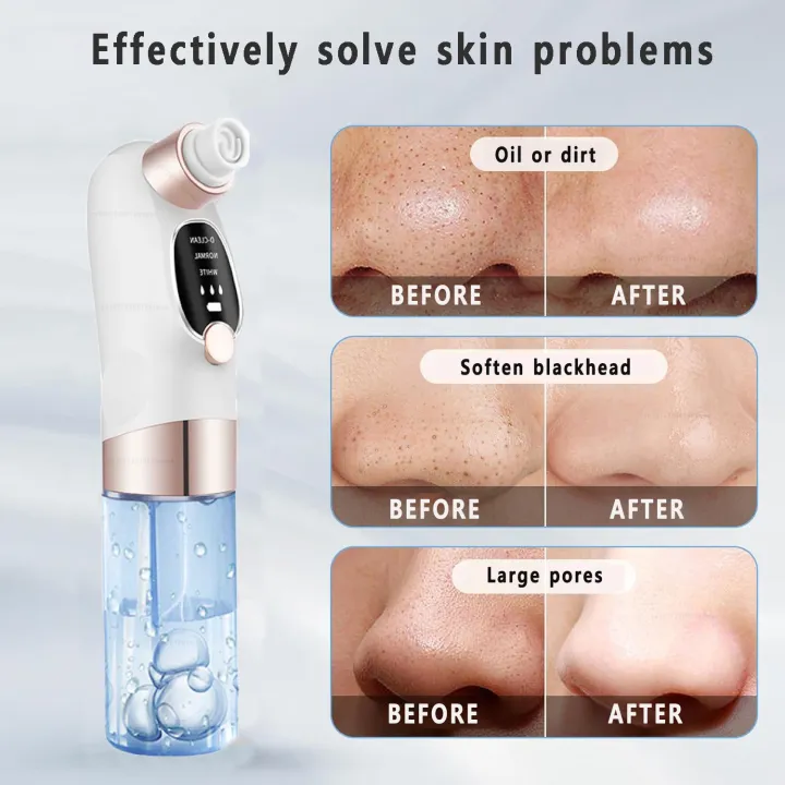 Blackhead%20Remover%20Pore%20Vacuum%20Face%20T%20Zone%20Cleaner%20Pimple%20Black%20Head%20Removal%20Electric%20Water%20Cycle%20Facial%20Nose%20Blackhead%20Removal%20-%20Image%206