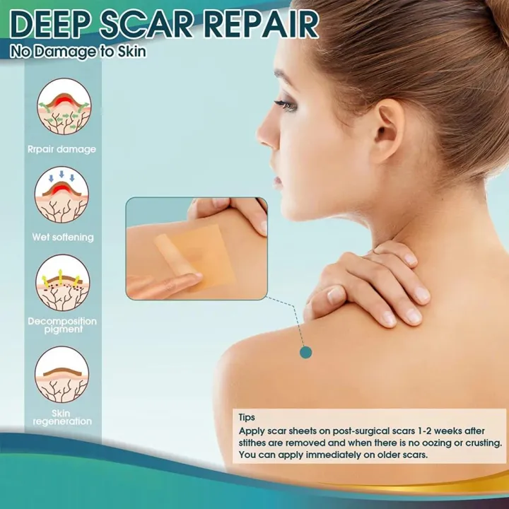 1Roll%20Professional%20Silicone%20Scar%20Sheets%20(Scar%20Tape%20-%20150cm)%20Scars%20Treatment%20-%20Reusable%20Silicone%20Scar%20Strips%20Type%20for%20Keloid,Burn%20-%20Image%202