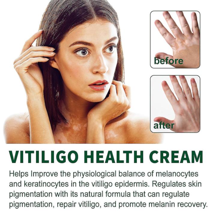 NUTRIG%20Vitiligo%20Treatment%20Cream%20for%20White%20Spots,%20Vitiligo%20Cream%20Treatment%20Ointment%20Leucoplia%20Relief%20Repair%20Melanin%2020g%20-%20Image%207