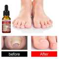 Ingrown Toenail Pain Relief Drops - 30ml. 