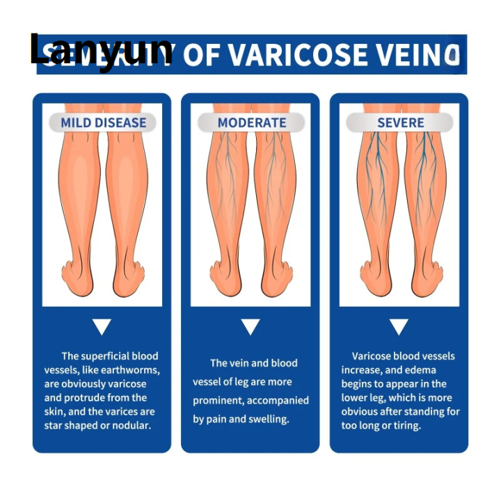 Lanyun%2020g%20Varicose%20Vein%20Relief%20Cream%20Tongmai%20Effective%20Relieves%20Leg%20Bulge%20Portable%20Pain%20Plant%20Extracts%20Treatment%20and%20Repair%20Cream%20Skin%20Care%20-%20Image%204
