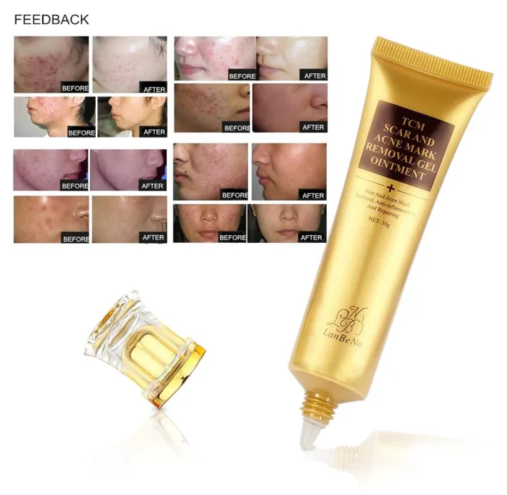 Original%20Scar%20and%20Acne%20Mark%20Removal%20Gel%20Stretch%20Marks/acne/scald/surgical%20Scars%20Treatment%20Cream%20Skin%20Care%2030%20Gram%20-%20Image%205
