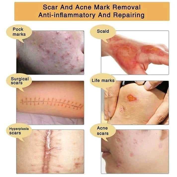 TCM%20Scar%20and%20Acne%20Marks%20Removal%20Gel,%20Scars,%20Burns,%20Stretch%20Marks,%20Acne%20Spots,%20Treatment%20Gel%20Ointment%20for%20Face%20and%20Body%2030g%20-%20Image%208