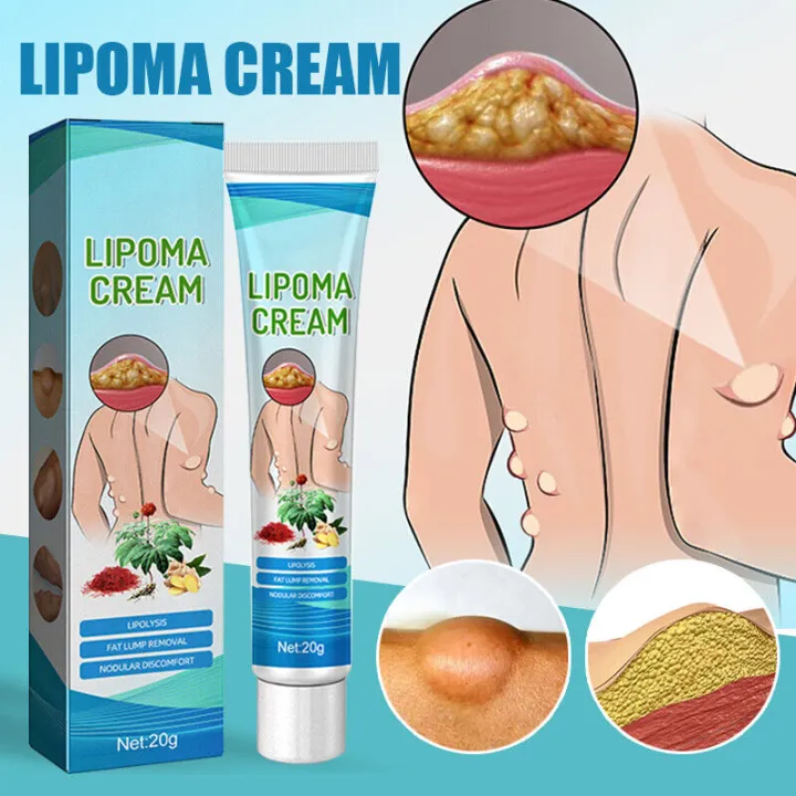 South%20Moon%20LumpFree%20Lipoma%20Removal%20Cream%20And%20Moisturizers-20g%20-%20Image%203