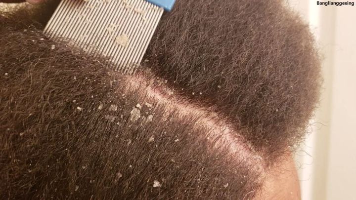 BanglianggexingLuxury%20Lice%20Comb%20No%20Nit%20Hair%20Rid%20Headlice%20Superdensity%20Stainless%20Steel%20Metal%20Teeth%20Remove%20Nits%20Brush%20Comb%20-%20Image%204