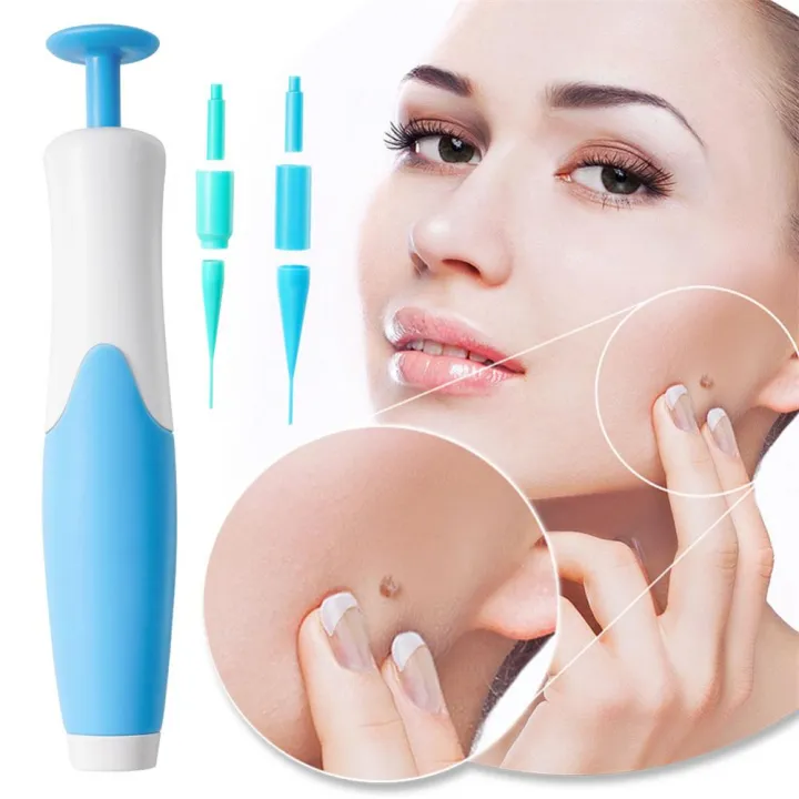 Huangdian%20Profesional%202In1%20Painless%20Auto%20Skin%20Tag%20Mole%20Wart%20Removal%20Kit%20Face%20Skin%20Care%20Body%20Wart%20And%20Dot%20Treatments%20Remover%20Plantar%20Warts%20Corn%20Removal%20-%20Image%203