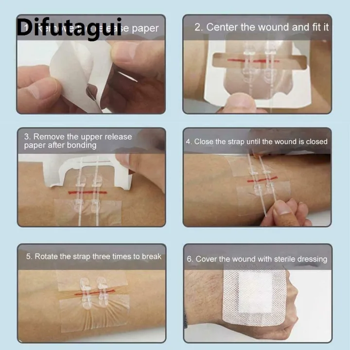 Difutagui%202025%20Zip%20Stitch%20Sutures%206x7cm%20Skin%20Laceration%20Closures%20Adhesive%20Bandages%20Zipper%20Band%20aid%20Patch%20for%20Emergency%20Wound%20Care%20First%20Aids%20-%20Image%205