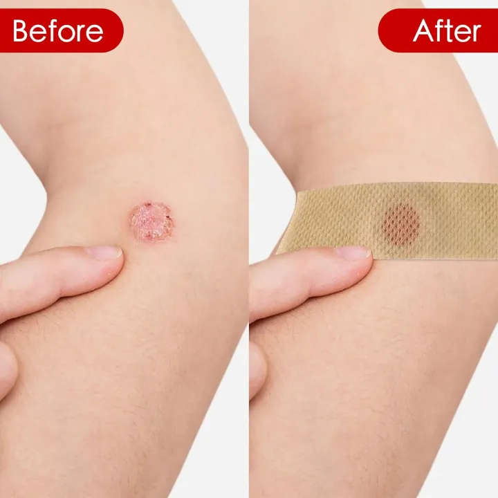 Pack%20Of%203%20Corn%20Remover%20Tape,%20Musa%20Kothi%20Hataune,%20Salicylic%20acid%20Tape%20-%20Image%205