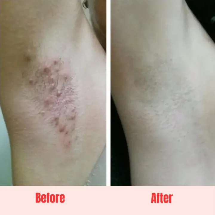 Girls%20Select%20Original%20Bikini%20Hair%20Removal%20For%20Whole%20Body%20Part,%20Smooth%20And%20Soft%20Skin,%20FREE%20Travel%20Pouch,%20Battery%20operated%20No%20Cuts%20No%20Ouchs%20-%20Image%206