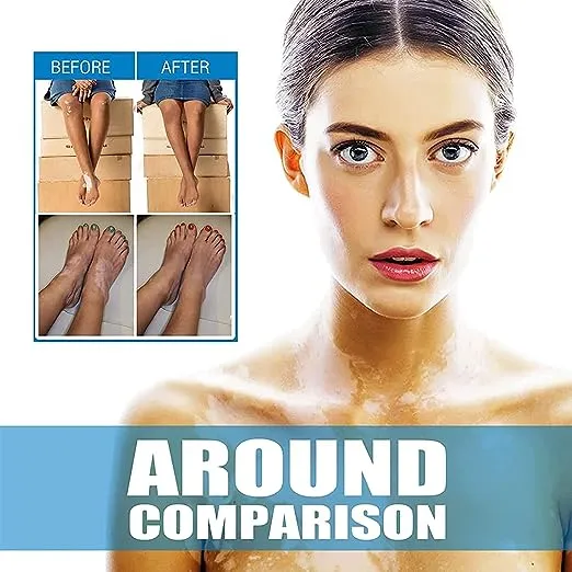NUTRIG%20Vitiligo%20Treatment%20Cream%20for%20White%20Spots,%20Vitiligo%20Cream%20Treatment%20Ointment%20Leucoplia%20Relief%20Repair%20Melanin/20g%20-%20Image%204