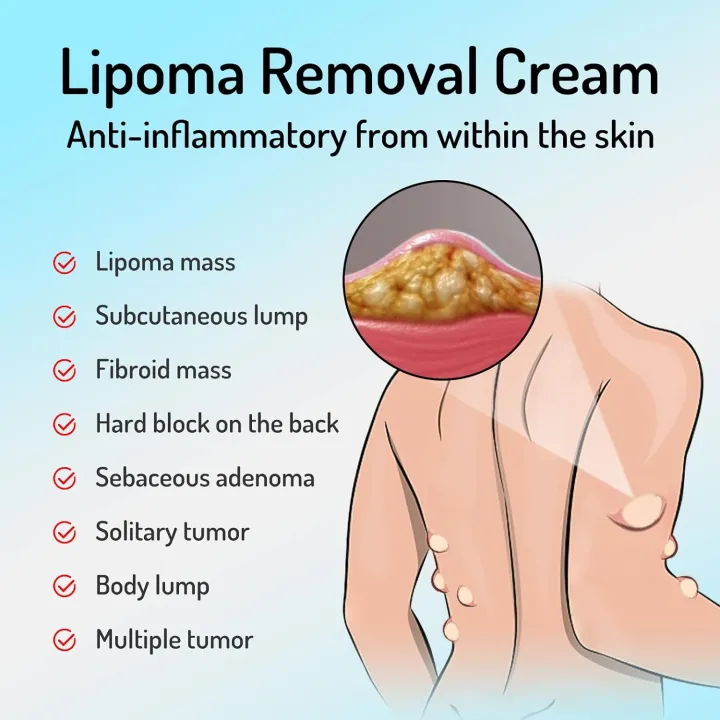 South%20Moon%20LumpFree%20Lipoma%20Removal%20Cream%20And%20Moisturizers-20g%20-%20Image%203