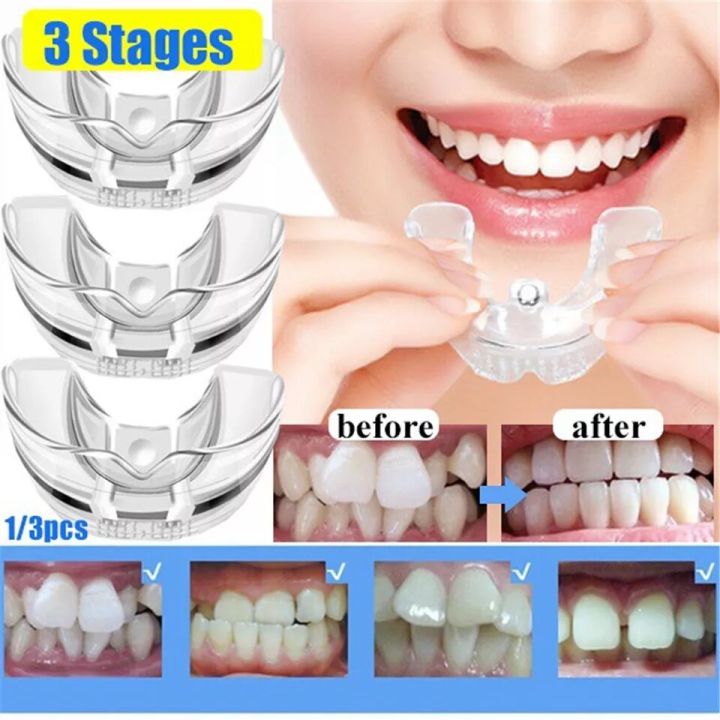Dental%20Orthodontic%20Teeth%20Corrector%20Braces%20Tooth%20Retainer%20%7C%20Removable%20Teeth%20Straightening%20Trainer%20Tool%20%7C%20Reusable%20Dental%20Alignment%20Corrector%20for%20Oral%20Care,%20Smile%20Support%20&%20Teeth%20Positioning%20(Adults%20&%20Teens)%20-%20Image%207