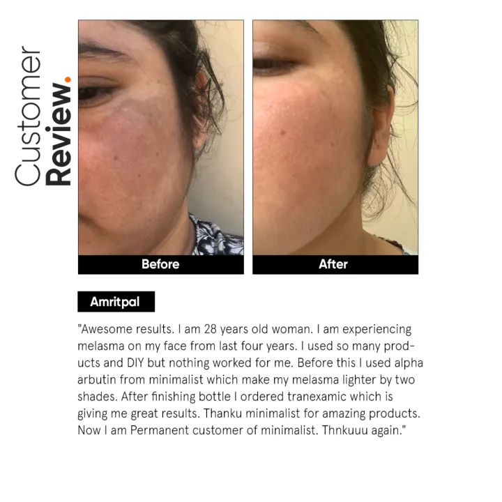 Minimalist%203%25%20Tranexamic%20Acid%20Serum%20for%20Brighter,%20Clearer%20Skin%20%7C%2030%20ml%20%7C%20Unisex%20%7C%20Reduces%20Melasma,%20Hyperpigmentation,%20PIE,%20PIH%20&%20Scars%20%7C%20From%20HyperMart%20%7C%20Hyper%20Mart%20%7C%20Election%20%7C%20buy%20during%20election%20commission%20nepal%20-%20Image%209