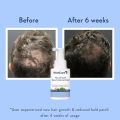 WishCare Hair Growth Serum For Scalp | 94% Saw New Hair Growth | Redensyl & Rosemary Oil | 100% Saw Hairfall Reduction | In-Vivo Tested | For Men & Women | 30ml. 
