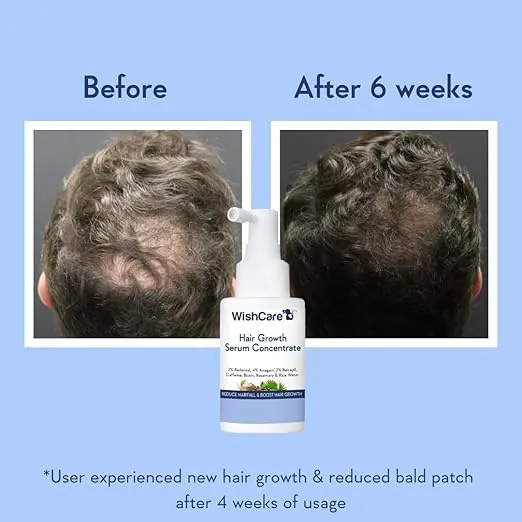 WishCare%20Hair%20Growth%20Serum%20For%20Scalp%20%7C%2094%25%20Saw%20New%20Hair%20Growth%20%7C%20Redensyl%20&%20Rosemary%20Oil%20%7C%20100%25%20Saw%20Hairfall%20Reduction%20%7C%20In-Vivo%20Tested%20%7C%20For%20Men%20&%20Women%20%7C%2030ml%20-%20Image%202